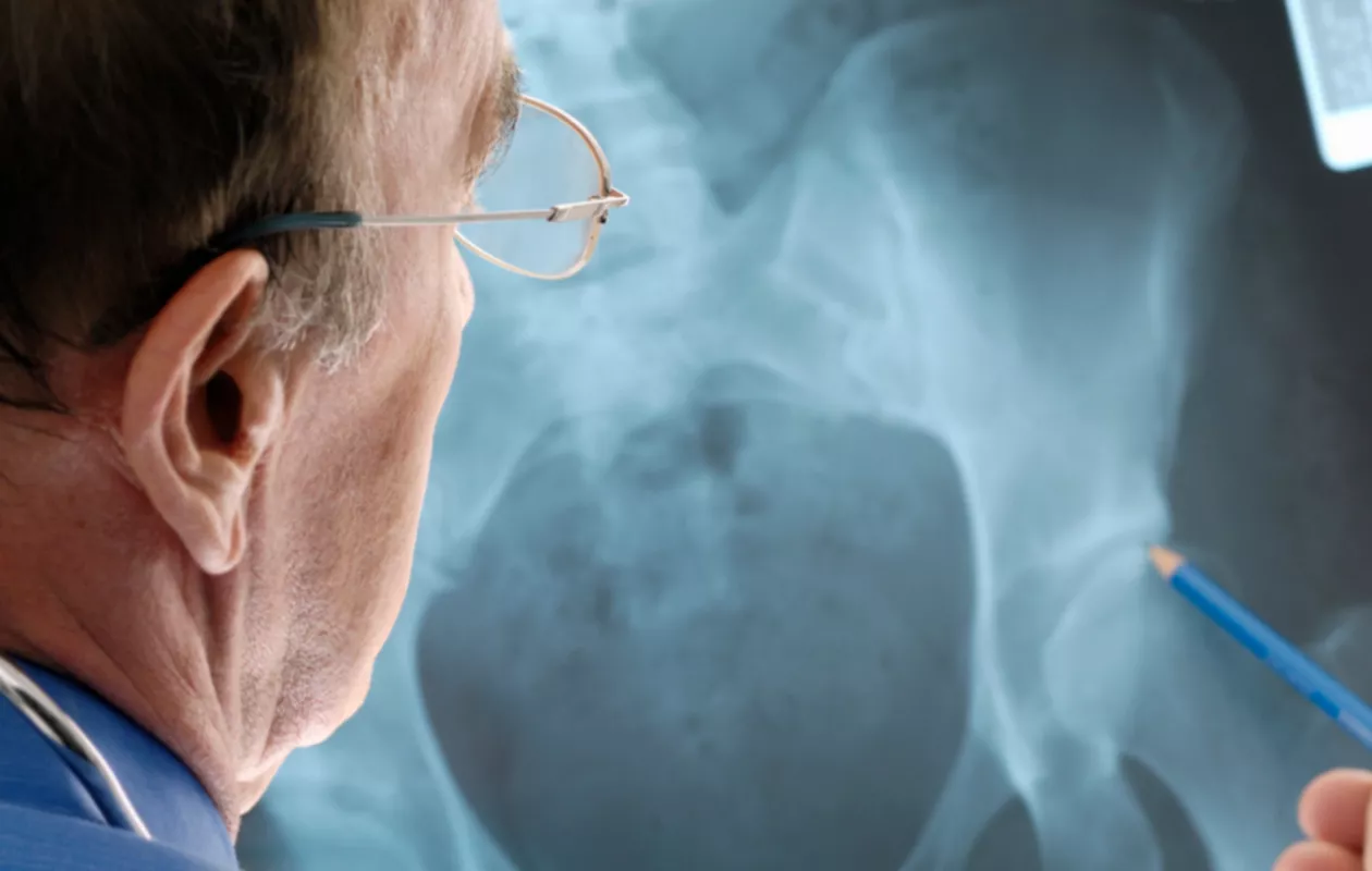 Osteoporoosi näkyy röntgenkuvissa.