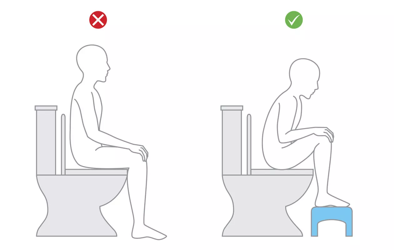 Ummetus voi helpottaa, kun asento vessanpöntöllä on oikea.