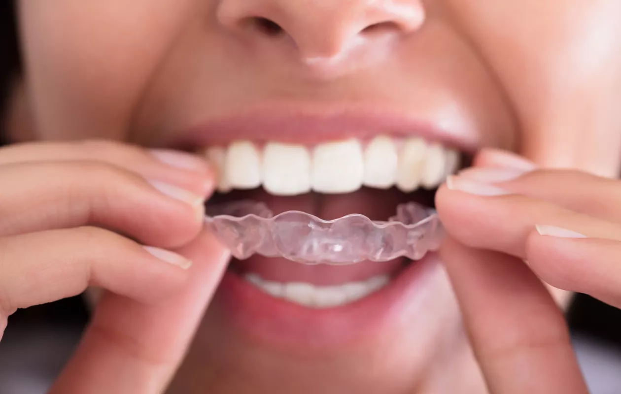 Hampaiden narskuttelu eli bruksismi: hoitokeinona on usein purentakisko.