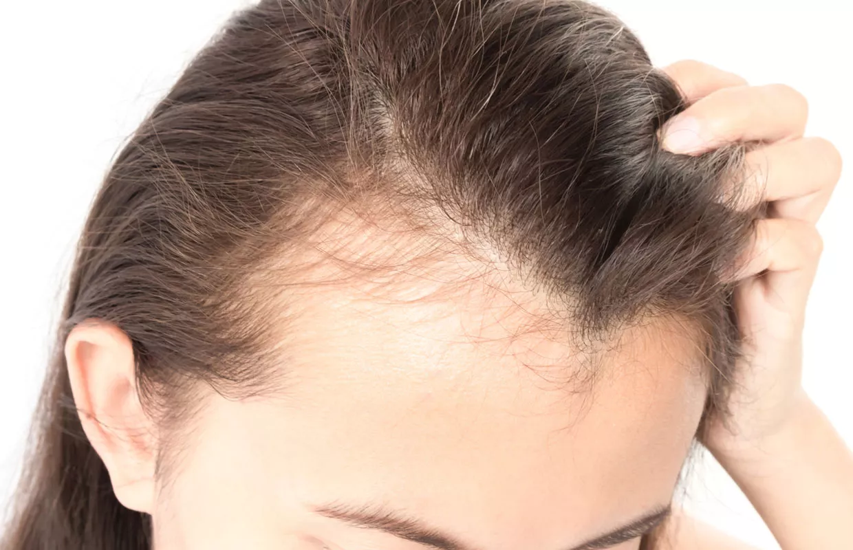Mistä hiustenlähtö johtuu? Miten hiustenlähtöä voi estää?