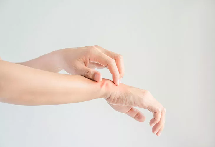 Aktiivisuusranneke ja ihottuma ovat ikävä yhdistelmä. Kuvassa henkilön kädet, jossa on ihottumaa. 