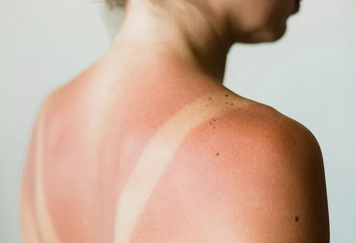 Ihon palaminen altistaa ihosyövälle. Kuvassa auringon polttama iho. 