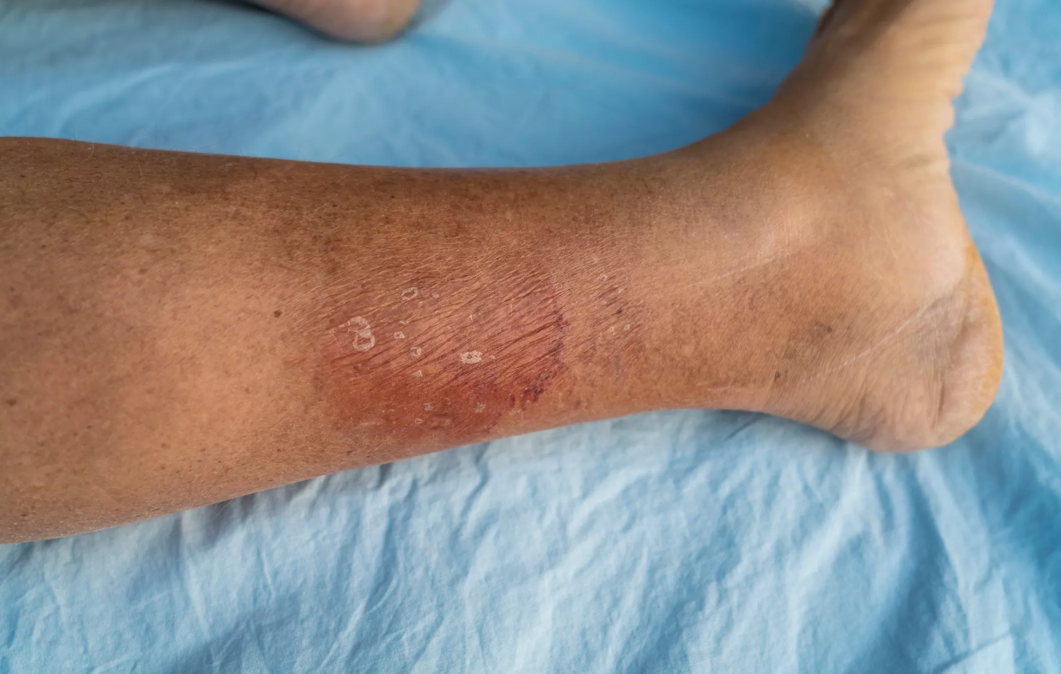 Ruusu esiintyy usein jalassa – näistä infektion oireista heti lääkäriin