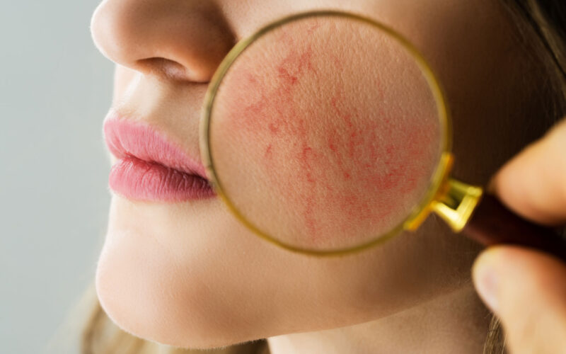 Couperosa-ihon punoitus voi pahentua, jos ihoa hoitaa liikaa – vain laserhoito lopettaa lehahtelun